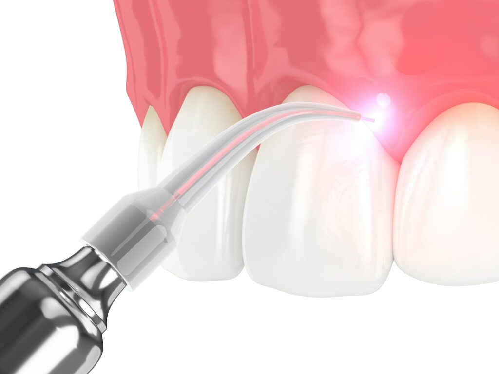 With laser dentistry in Quakertown, PA, you can reap the benefits of one of dentistry’s newest technological advancements.