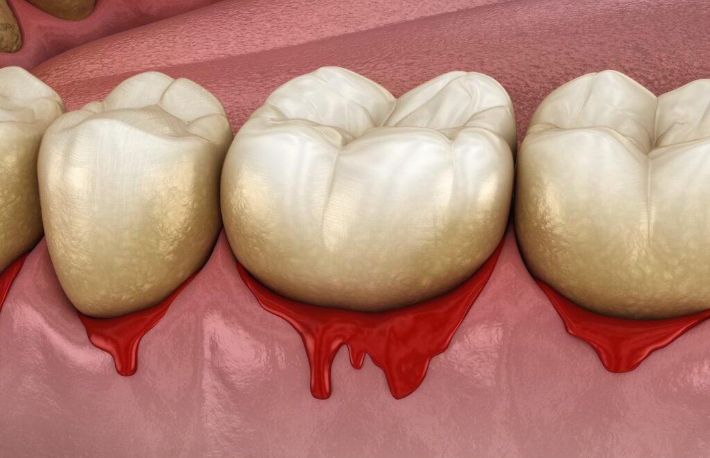 Bleeding gums are an early sign of gum disease that should not be ignored as they can progress to more severe stages without proper care.