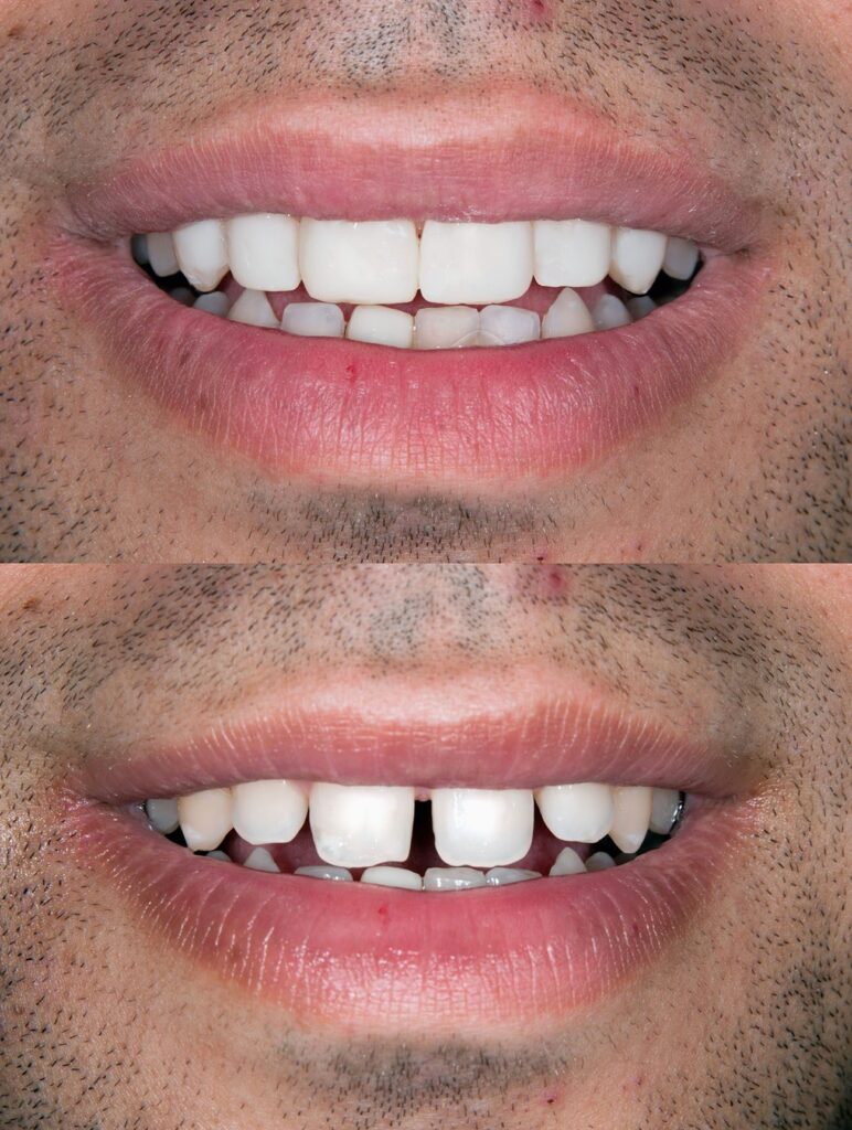 Understanding the advantages of porcelain veneers could help you make an informed decision about whether this dental procedure is for you.