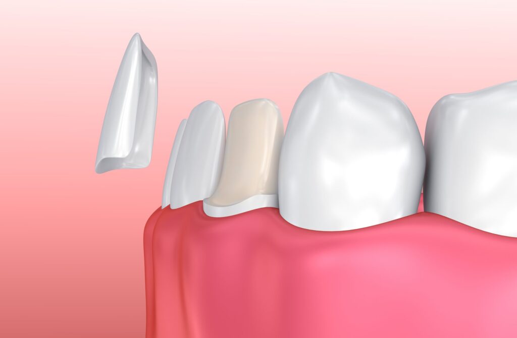 PORCELAIN VENEERS in QUAKERTOWN PA are a versatile treatment option for many dental concerns